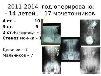 Презентация Уретероимплантация 2 стр.